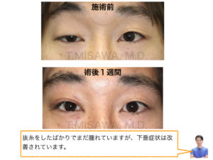 先天性眼瞼下垂症（筋膜移植）